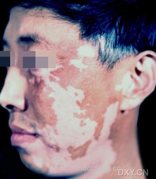 白癜风病因或病在内分泌失调