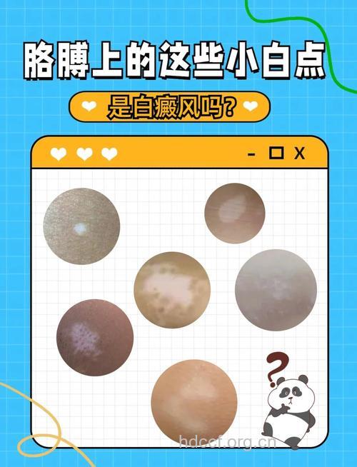 不同颜色的白癜风,选用不同的治疗