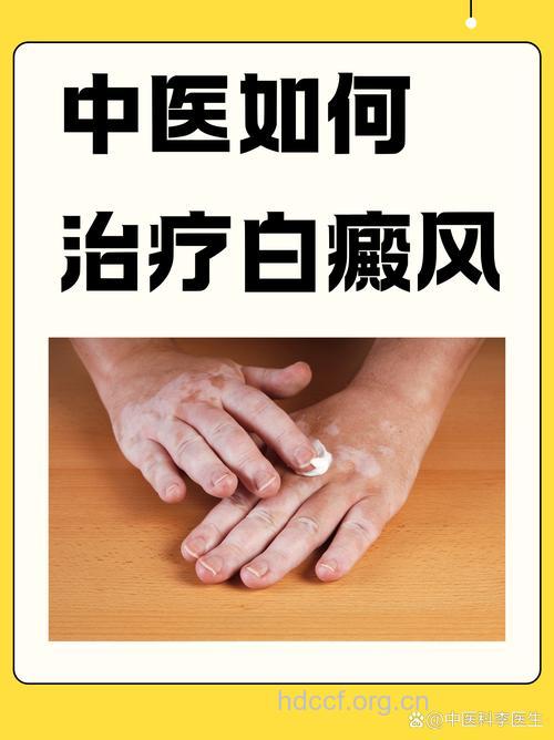 中医泻法治疗白癜风