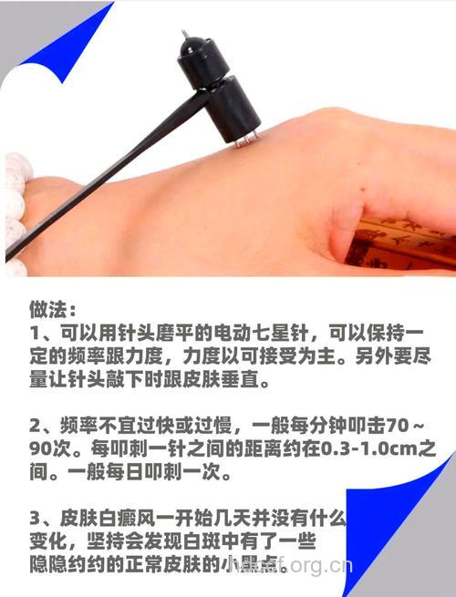 治疗白癜风不妨试试中医针灸法