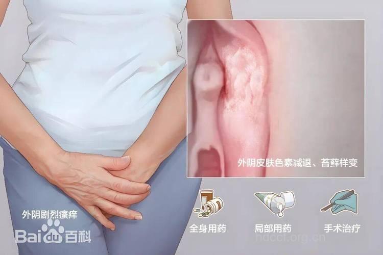 我的外阴长了白斑是怎么回事？
