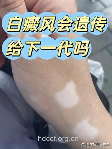 白癜风并非百分百遗传