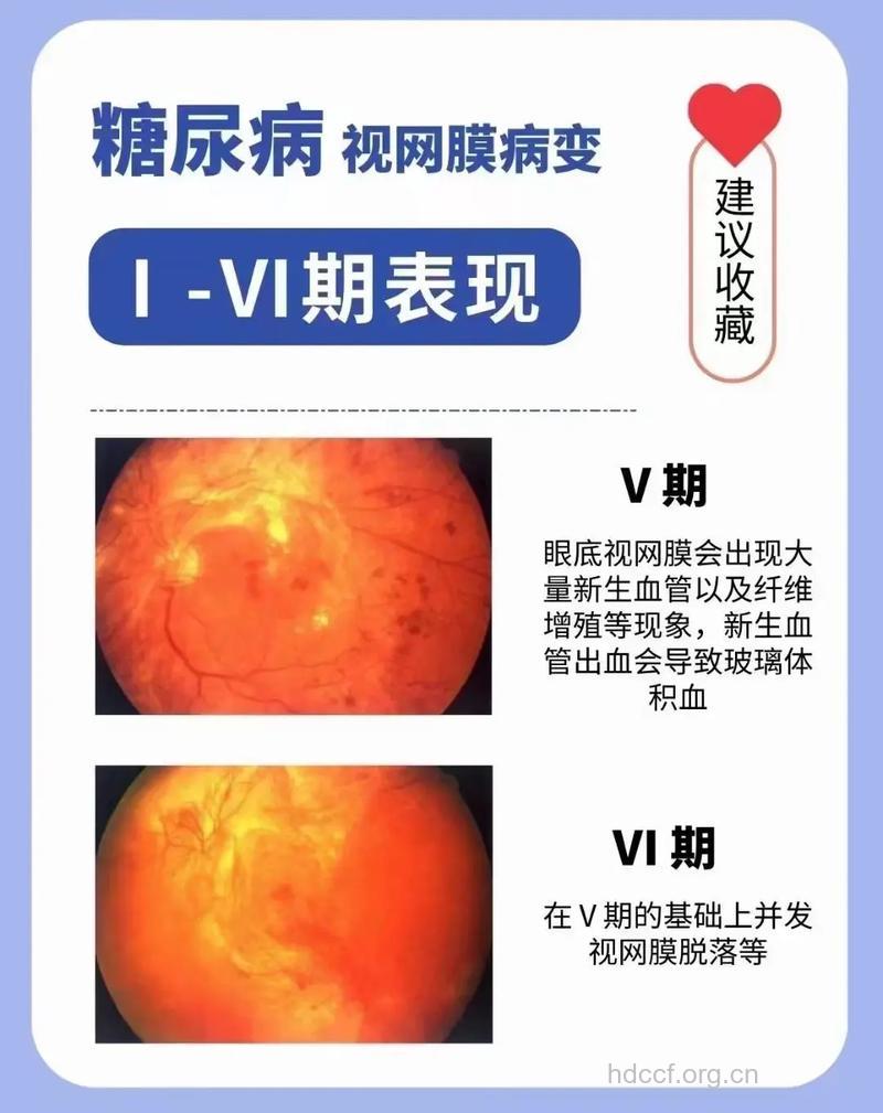 怎么防糖尿病性视网膜出血