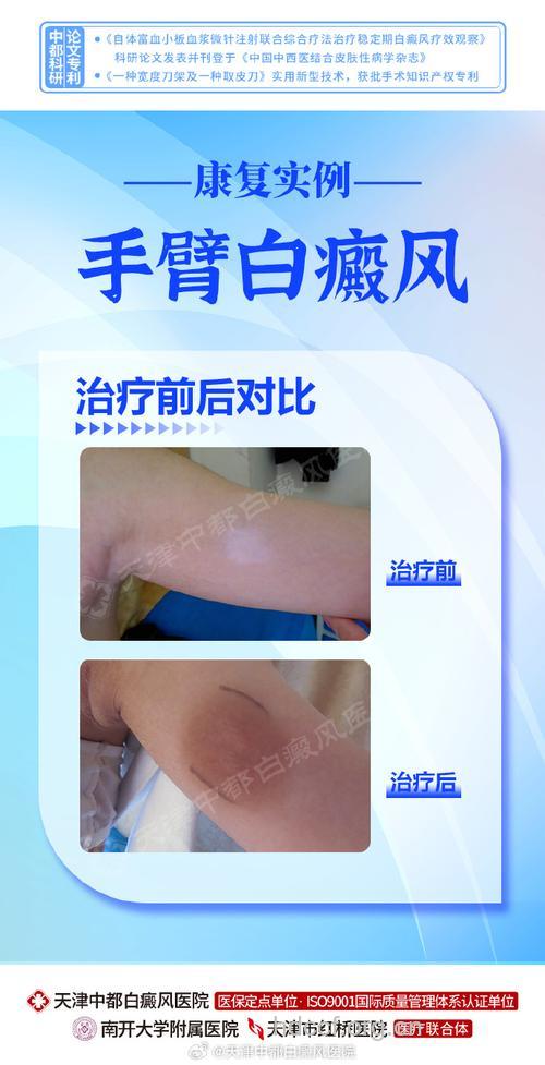 激光辅助移植治疗白癜风