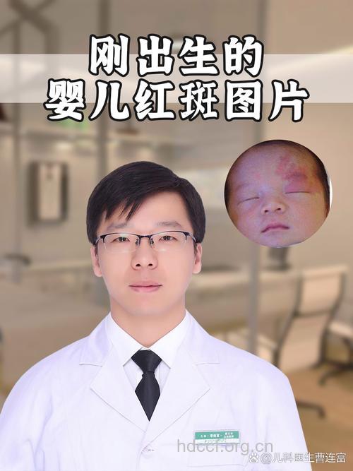 新生儿脸上有红斑正常吗