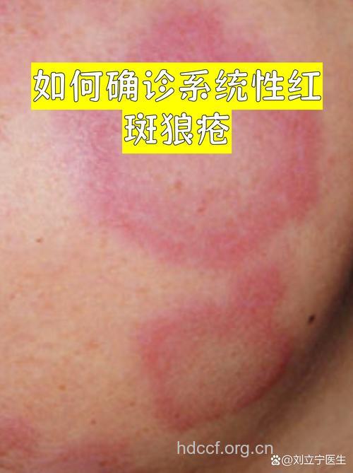 如何确诊红斑?
