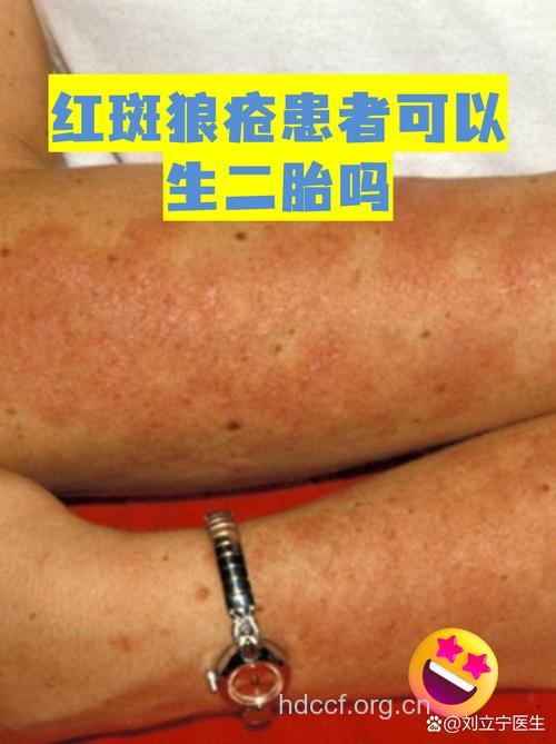 红斑狼疮患者可以结婚生子吗