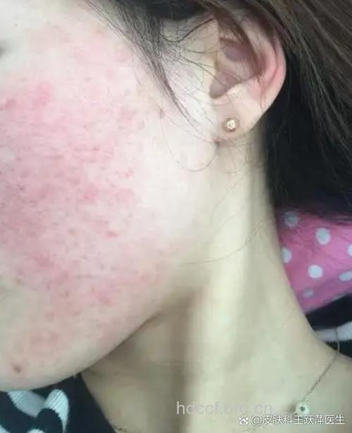 劣质面膜易引发红斑