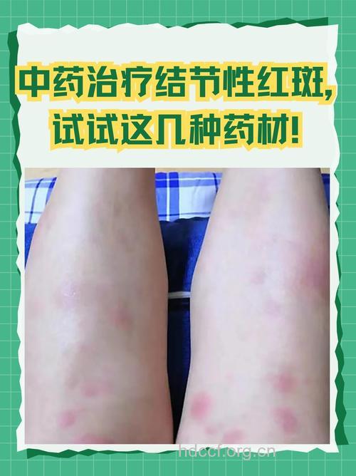 红斑的治疗有哪些特点