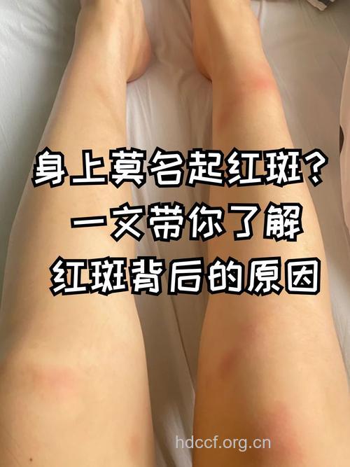 红斑有多么可怕你知道吗？