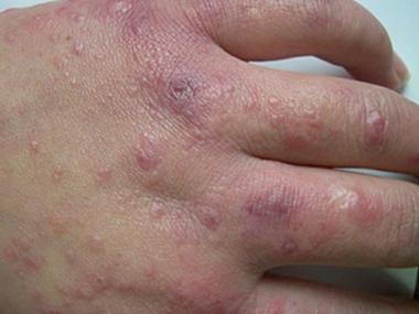 寒冷性多形性红斑