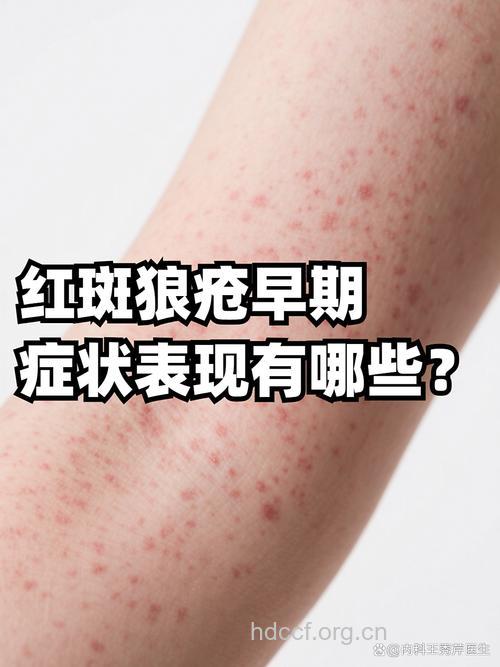 红斑狼疮有哪些主要症状