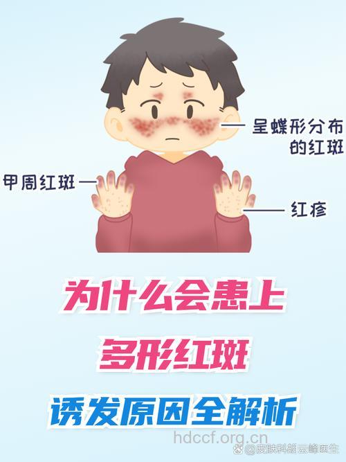 为什么会得多形性红斑？