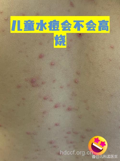 激素会使水痘泛发加剧病情