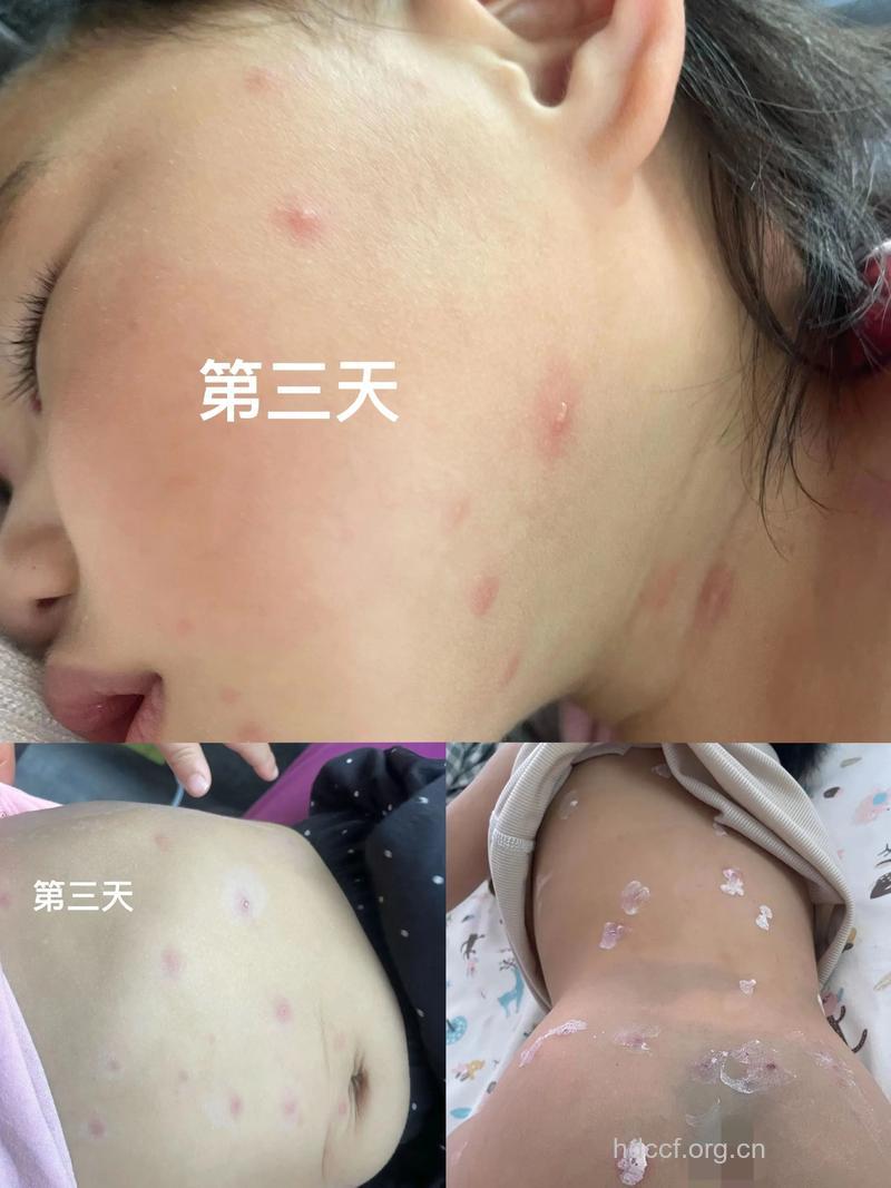 宝贝们的初夏战“痘”