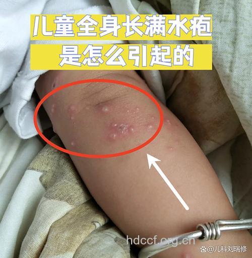 水痘不是孩子的专利