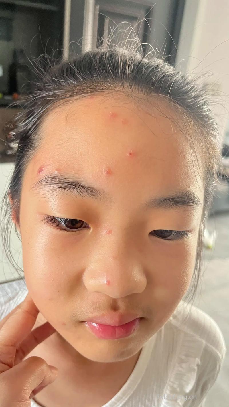 水痘不可怕 10天之内可自愈