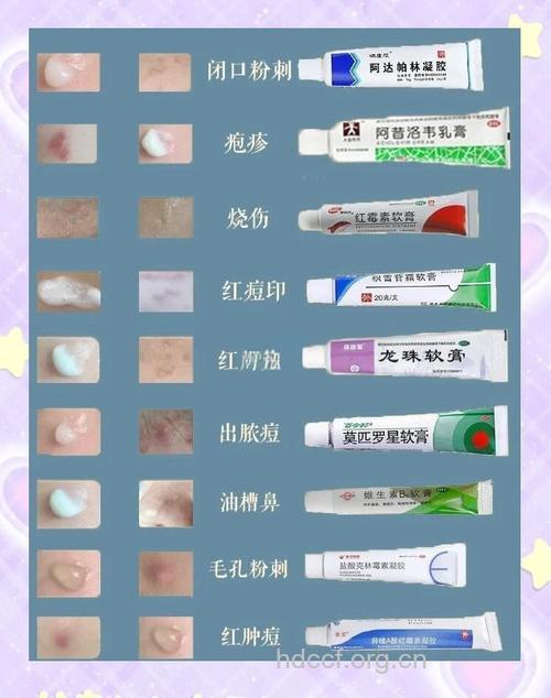 长水痘远离激素类软膏