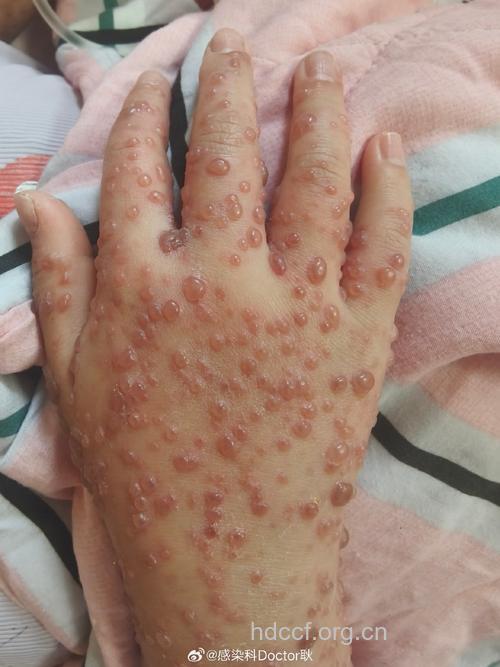 水痘的传染性很强