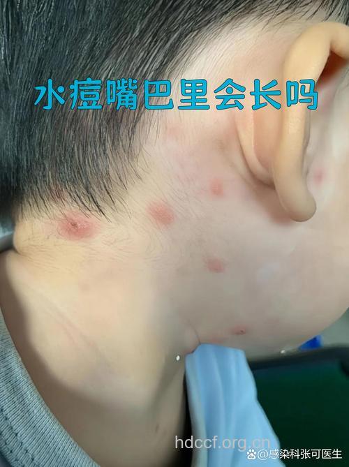 惊！水痘也会致命