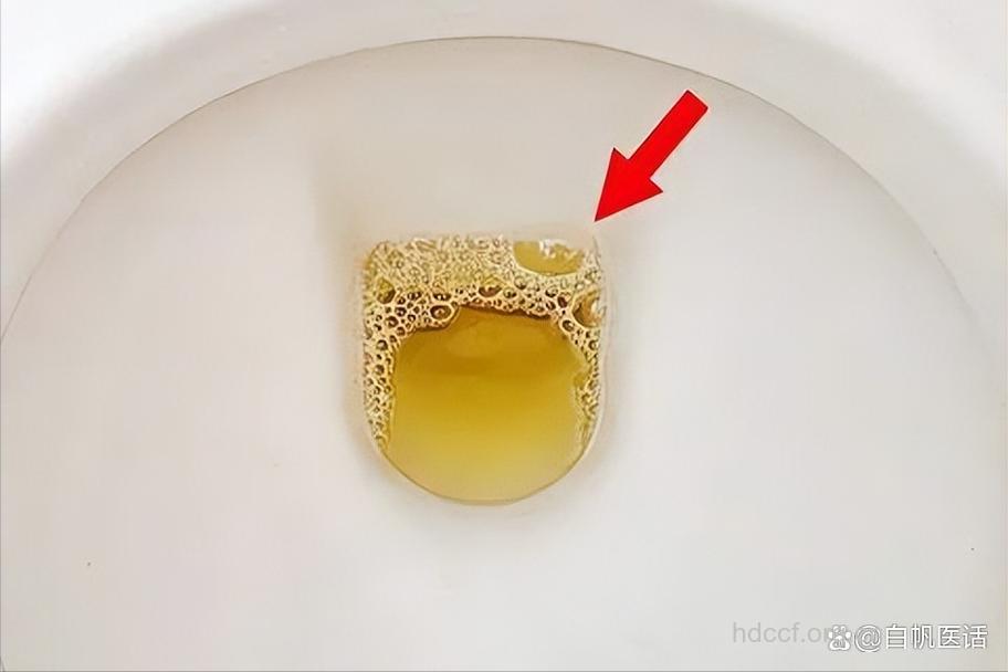 小便有泡沫 这会是糖尿病吗?
