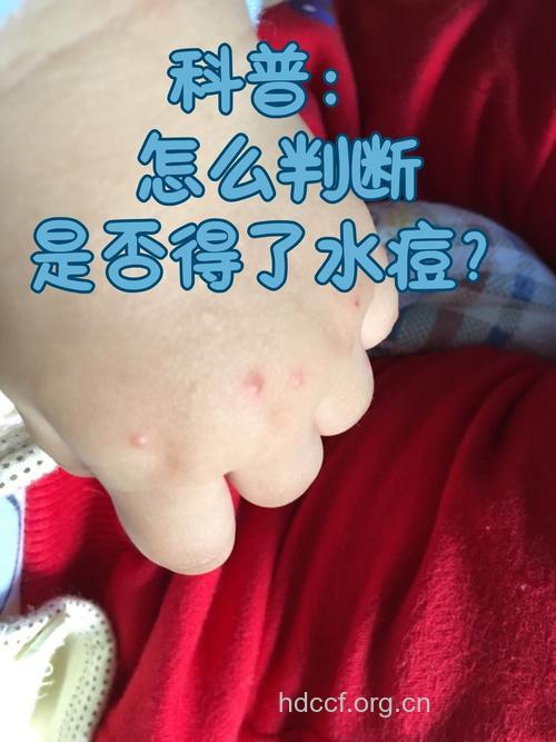 什么是不典型水痘