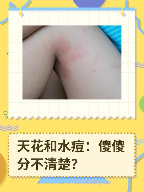 天花与水痘的区别在哪里