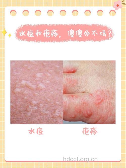 水痘与带状疱疹有哪些区别