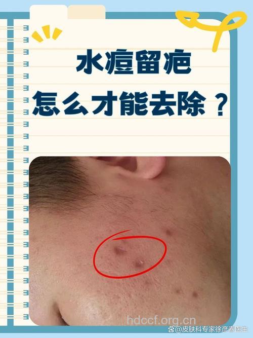 怎样治疗水痘后留下疤痕