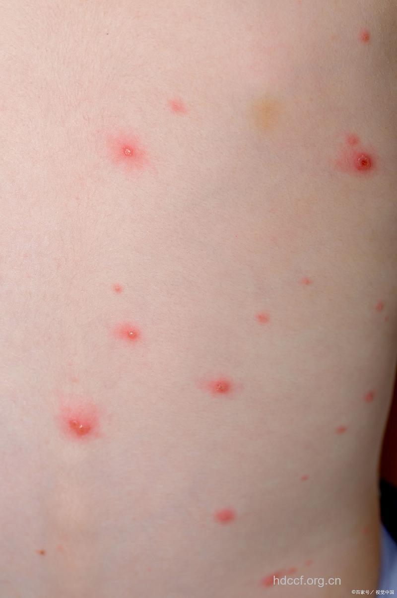 水痘有哪些临床表现