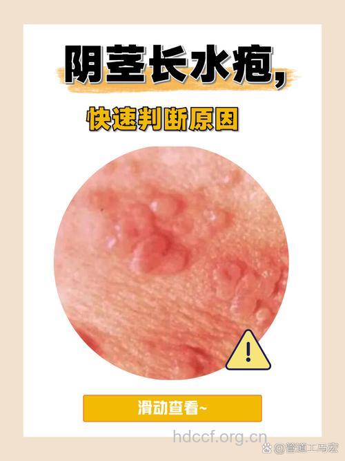 成人为什么会长水痘