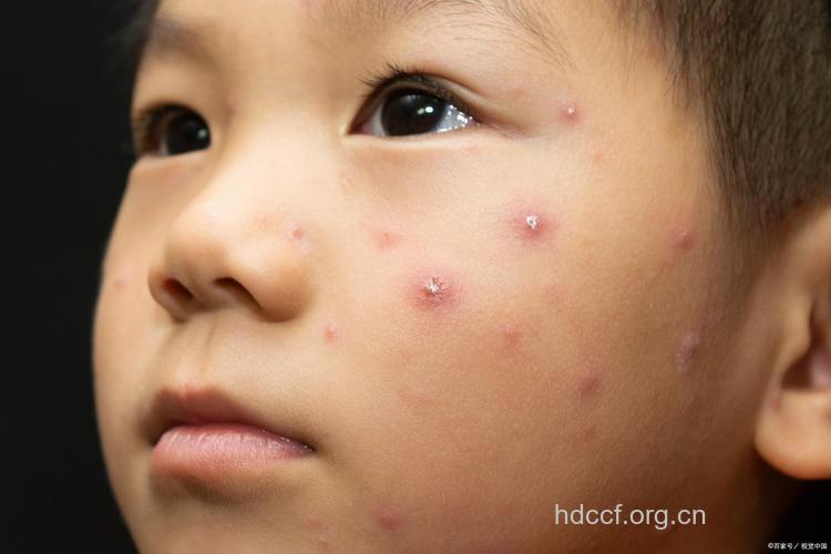 2至10岁儿童易发水痘