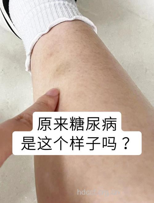1型糖尿病早期有哪些症状