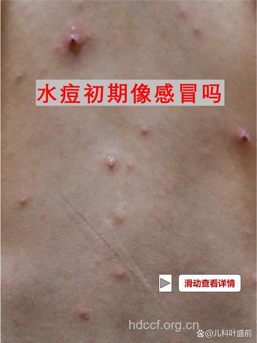 水痘的初发症状跟感冒相似