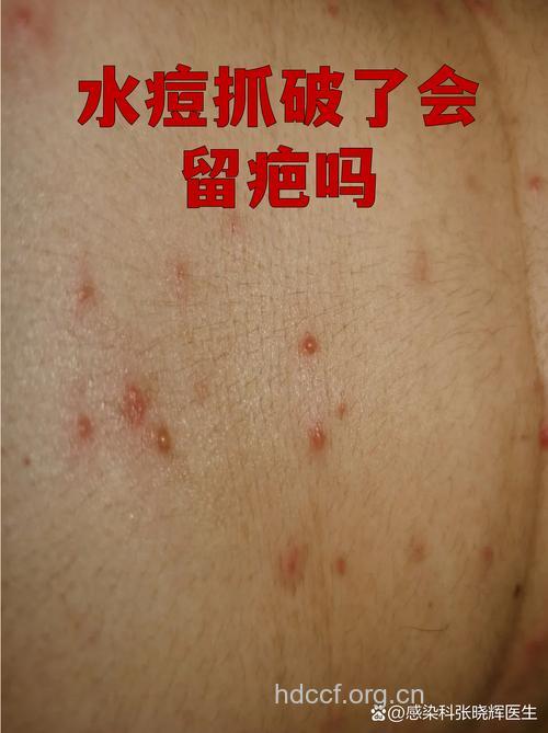 水痘若不注意皮肤清洁也会留下疤痕