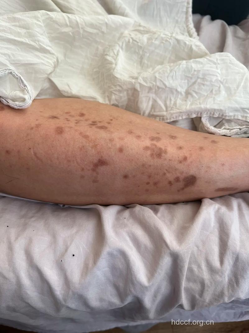 糖尿病几种早期皮肤症状