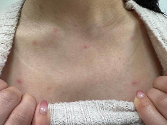 18至25岁成人 水痘也高发