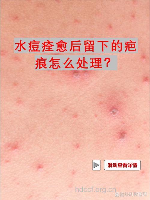 水痘康复后会留下疤痕吗？