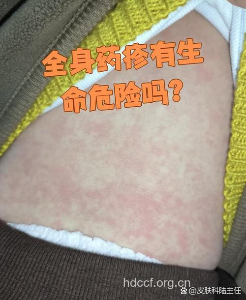 重症药疹会危及生命吗?