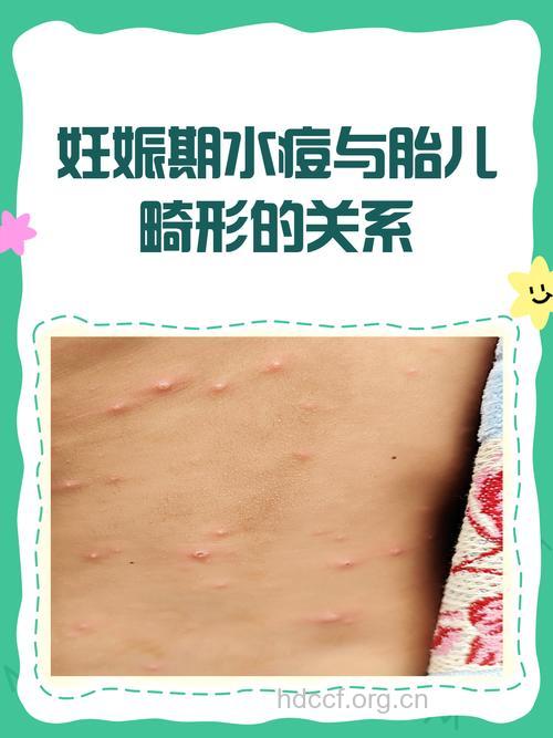 孕期感染水痘可能引起胎儿畸形