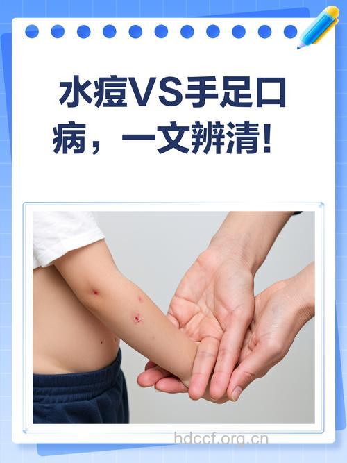水痘易于手足口病混淆