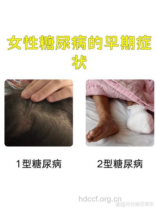 女性糖尿病的早期症状