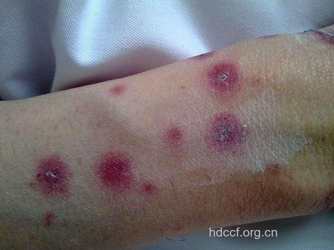 传染性红斑有哪些症状