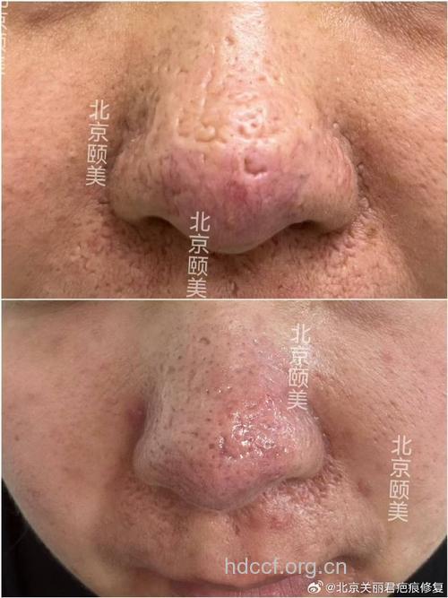 激光能治疗酒渣鼻吗