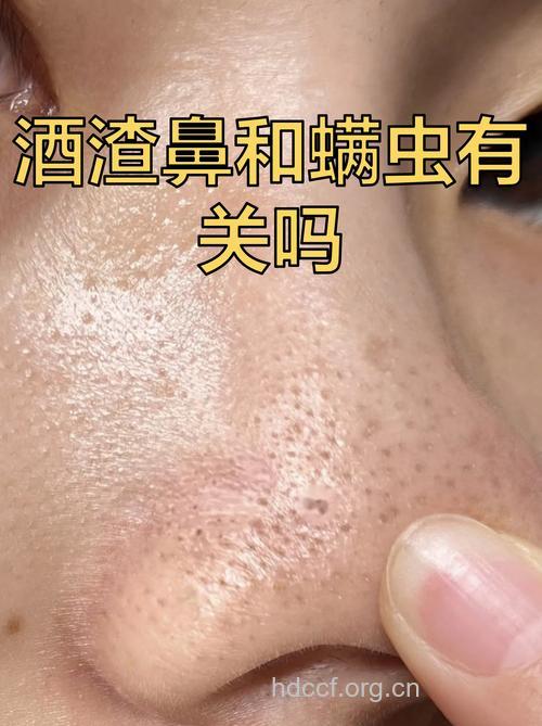 螨虫？上火？ 谁是酒渣鼻真凶