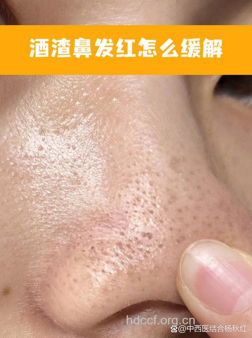 小心，别让酒渣鼻“进级了”