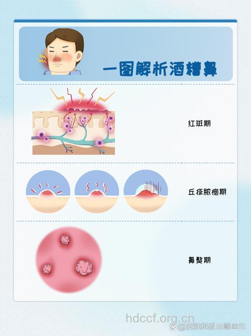 酒糟鼻症状的一系列演变过程