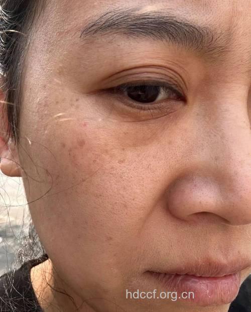 冬季女性穿衣少易长色斑