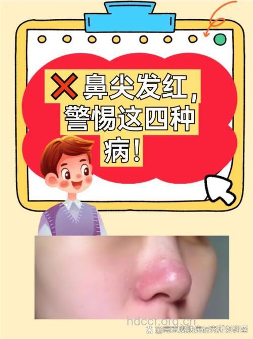 为何会出现红色的酒渣鼻