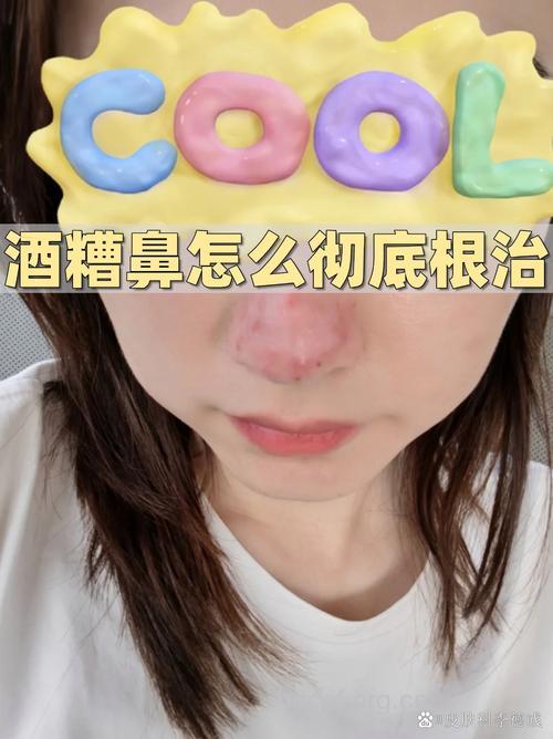 酒渣鼻不是喝出来的